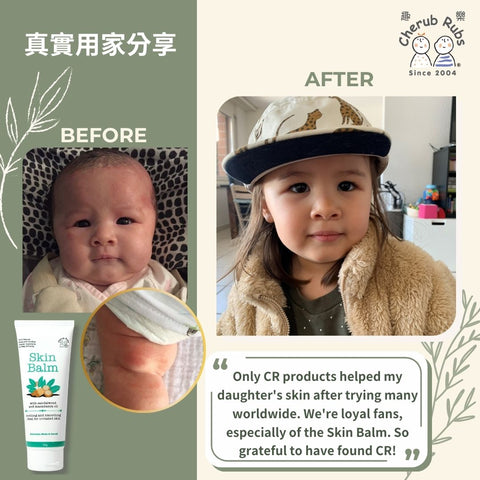 The Only Solution: How CR Products Changed skin of My Daughter