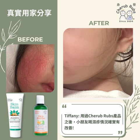 Bb面部同手都出現濕疹